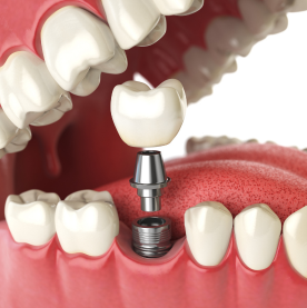 Bogura’s trusted dental care for painless tooth extraction services